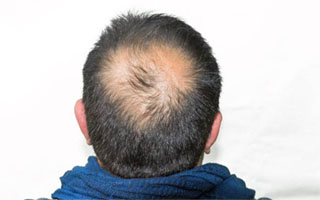 Ayurvedic Remedies To Treat Bald Patches