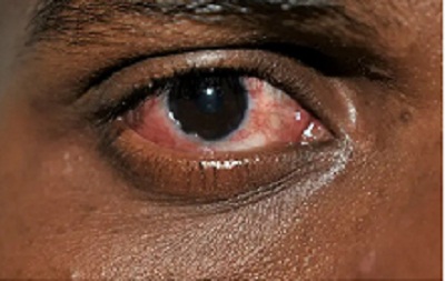 Doctors see 40% rise in viral conjunctivitis among kids, adults